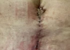 Tummy Tuck 3 (002)