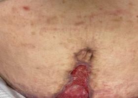 Tummy Tuck 4 (002)
