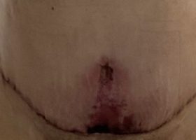 Tummy Tuck_ (002)